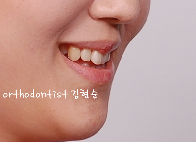 개방 교합 관련 이미지 4