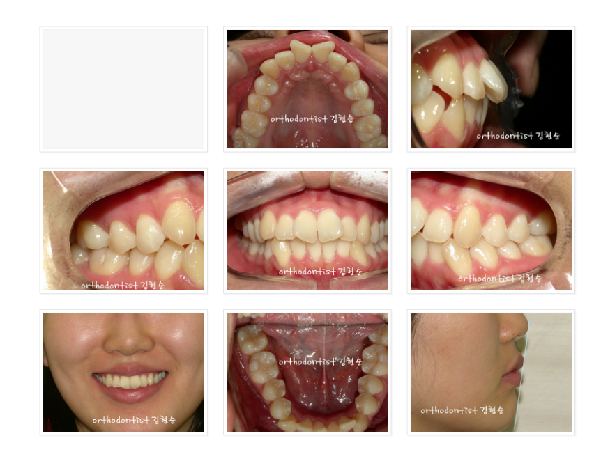앞니가 돌출된 경우, 발치 교정 후 블랙 트라이앵글(치아 사이 공간) 삭제 관련 이미지 2