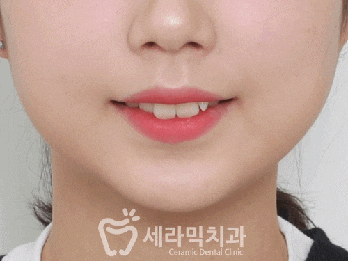 딥바이트(과개교합) 때문에 감추고 싶던 치아, 치아교정전후 달라진 미소 관련 이미지 6