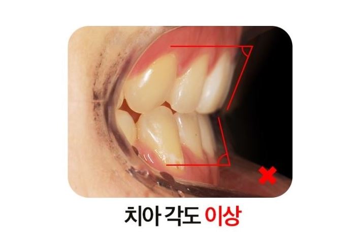 돌출입교정 옥니 부작용 방지 교정브라켓 관련 이미지 2