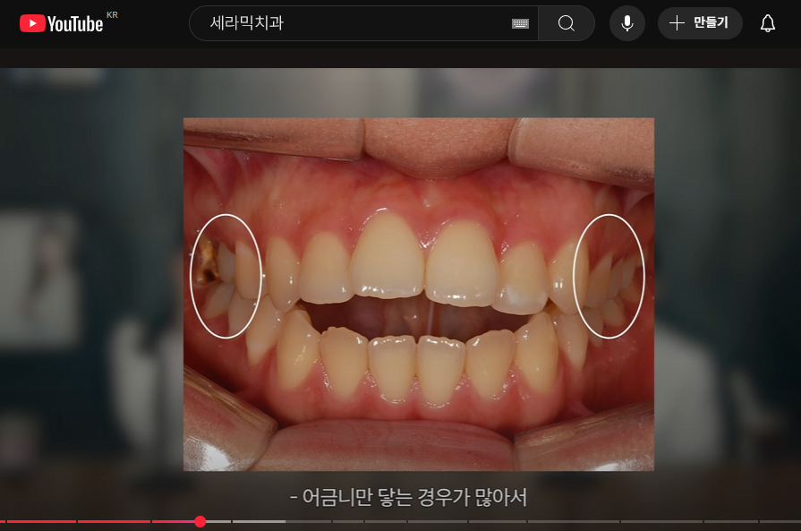 학동역치과 성인 돌출입교정, 비수술 · 비발치 고민하고 있다면 관련 이미지 5