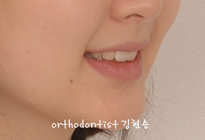 강남 돌출 (토끼 치아) 관련 이미지 32