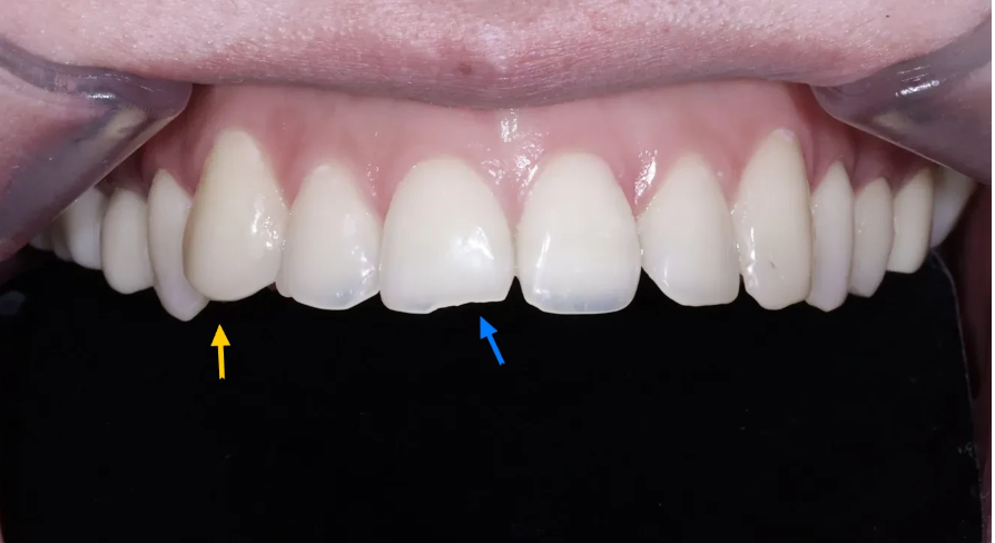 치아부식과 심미성을 동시에 잡은 앞니 치료 (ft. 역류성 식도염) 관련 이미지 5