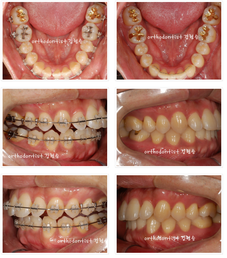 들쑥날쑥한 아래 앞니, 발치 후 교정 관련 이미지 4