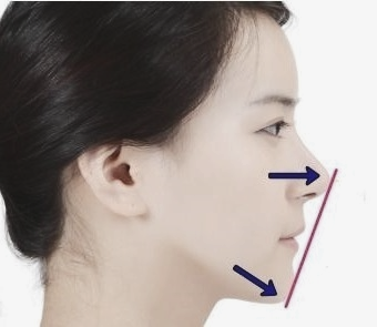 학동역치과 하면 세라믹교정 ~ 관련 이미지 9