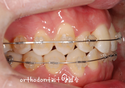 반대교합 관련 이미지 16
