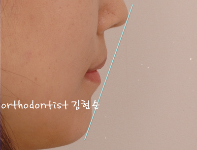 개방 교합 관련 이미지 33