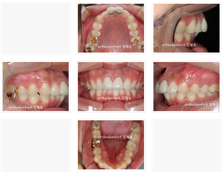 세라믹교정 세라믹치과-돌출입발치교정 1 관련 이미지 2