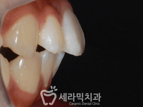돌출입 치아교정전후 : 세련된 얼굴라인 찾기 성공! 관련 이미지 2