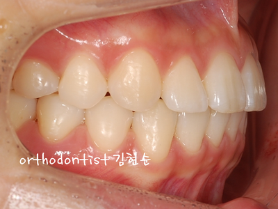 돌출 교정 (비발치 교정/비대칭) 관련 이미지 29