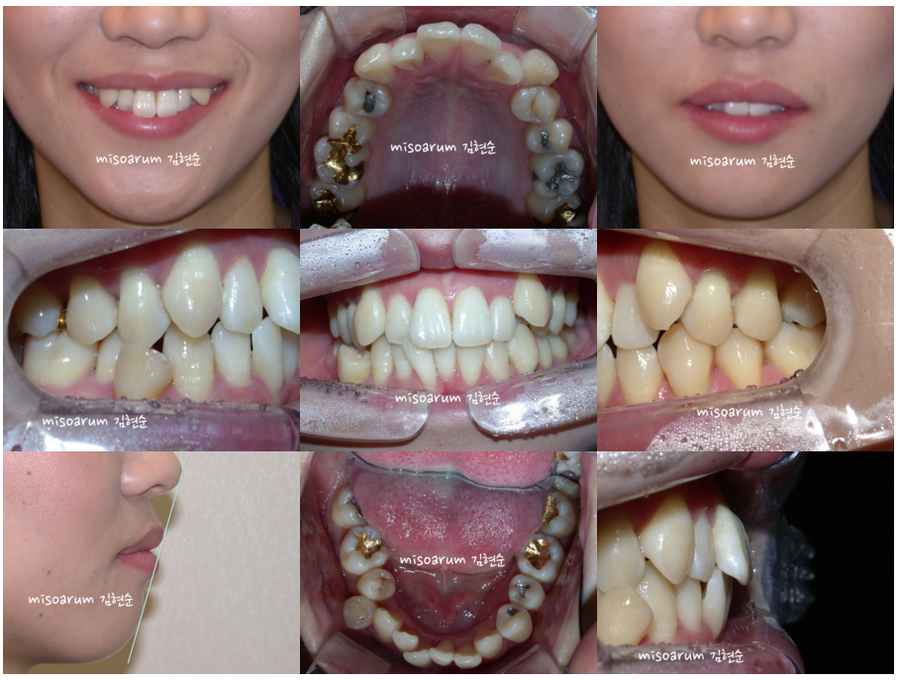 세라믹교정 덧니교정 관련 이미지 4