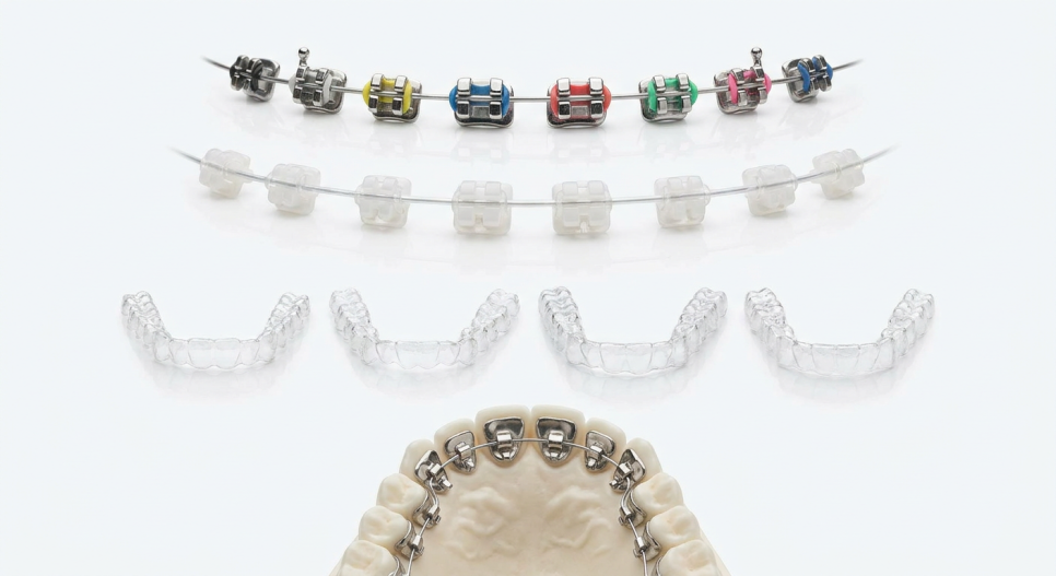 Protruding Mouth Orthodontic Treatment: What You Should Know Before Starting image 5