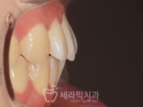 20대 돌출입교정, 무턱교정, 치아교정전후 세련된 얼굴 라인을 되찾다! 관련 이미지 5