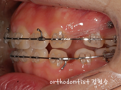 강남 돌출 관련 이미지 27