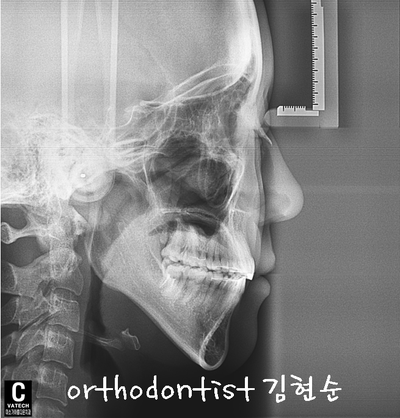 치열 교정(치열 불규칙) 관련 이미지 34