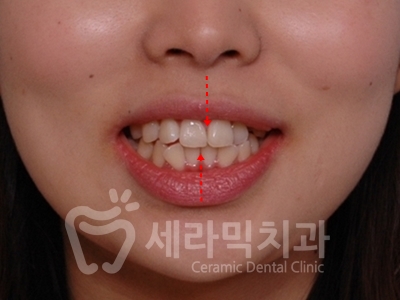 돌출입 덧니 비대칭 치아교정 전후 인상변화! 관련 이미지 4