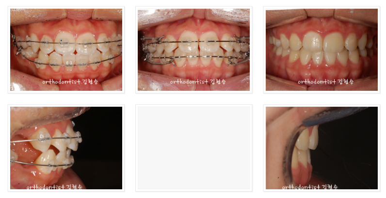 미니스크류를 이용한 발치 돌출입 교정, 무턱 개선 관련 이미지 6