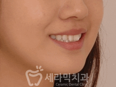 앞니 돌출, 나비치아를 남몰래 해결한 치아교정 전후! 관련 이미지 1