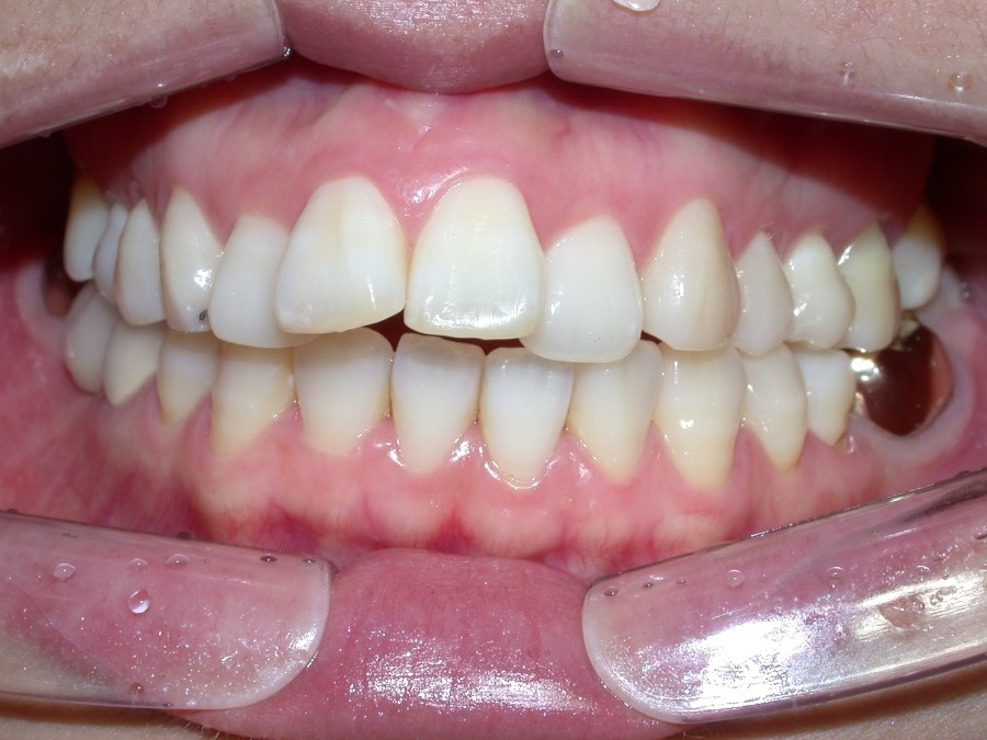 [강남치아교정] 치아교정기간 줄이는 방법 관련 이미지 7