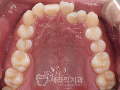 A Case of Overretained Teeth and Deep Bite Orthodontics That Helped the Patient Smile Confidently Before and After image 7