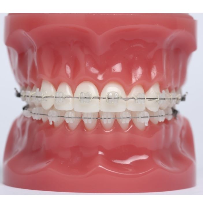 세라믹치과 수술없이 돌줄입교정 관련 이미지 5