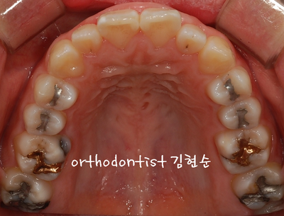 강남 돌출 관련 이미지 6