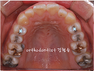 강남 돌출입 교정 관련 이미지 18