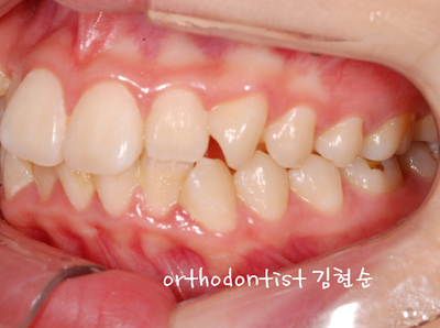 강남 돌출 (토끼 치아) 관련 이미지 10