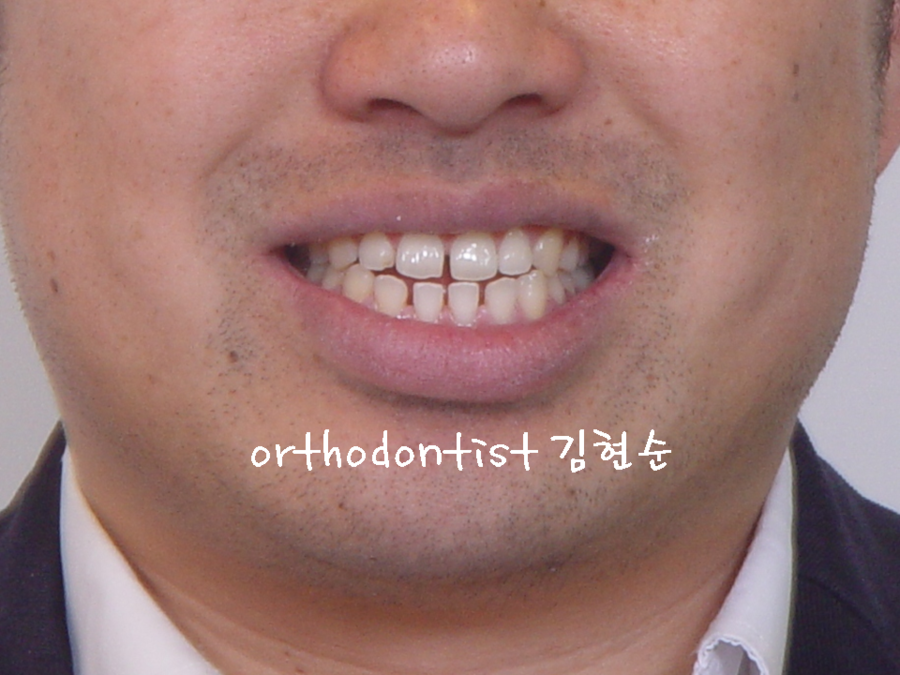 세라믹치과 나이들어 하는 치과 교정 궁금증 관련 이미지 3