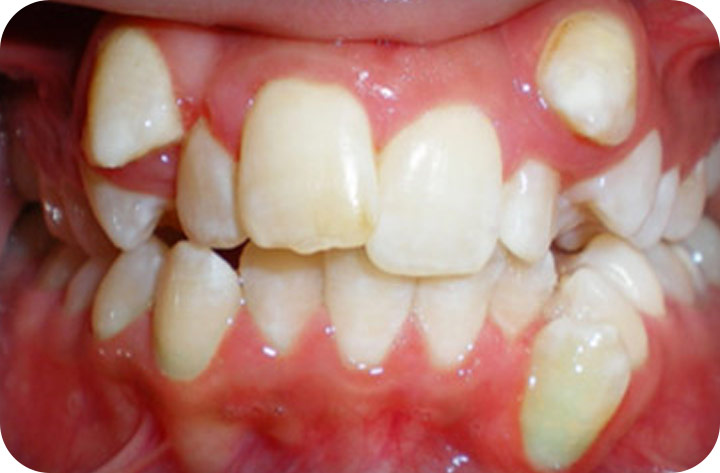 강남치아교정 브라켓비교분석 관련 이미지 22