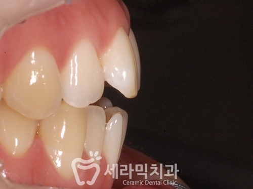 상실된 치아가 있어도, 금니가 있어도 치아교정전후는 계속된다! 관련 이미지 1