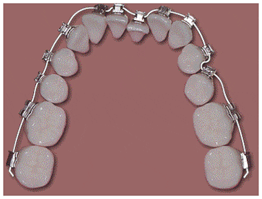 클리피씨교정 기간 짧을까? 관련 이미지 4