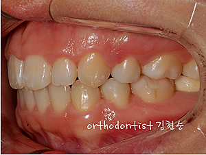 강남 돌출입 교정 관련 이미지 29