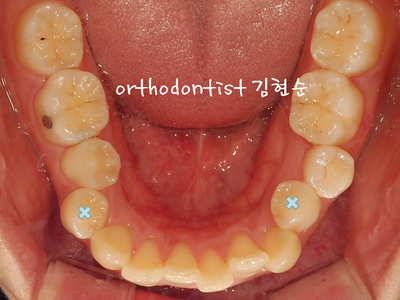 강남 돌출 관련 이미지 13