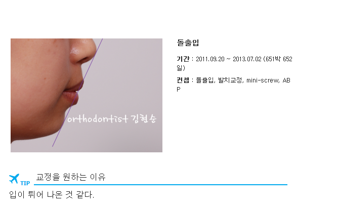 세라믹교정 세라믹치과-돌출입발치교정 7 관련 이미지 1