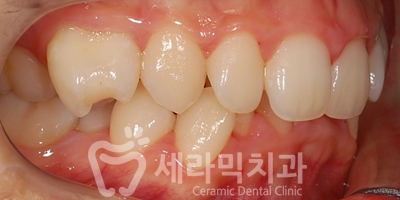 과개교합 치아교정잘하는곳, 세라믹치과 치아교정전후! 관련 이미지 12
