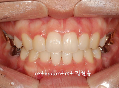 강남 돌출입 교정 관련 이미지 17