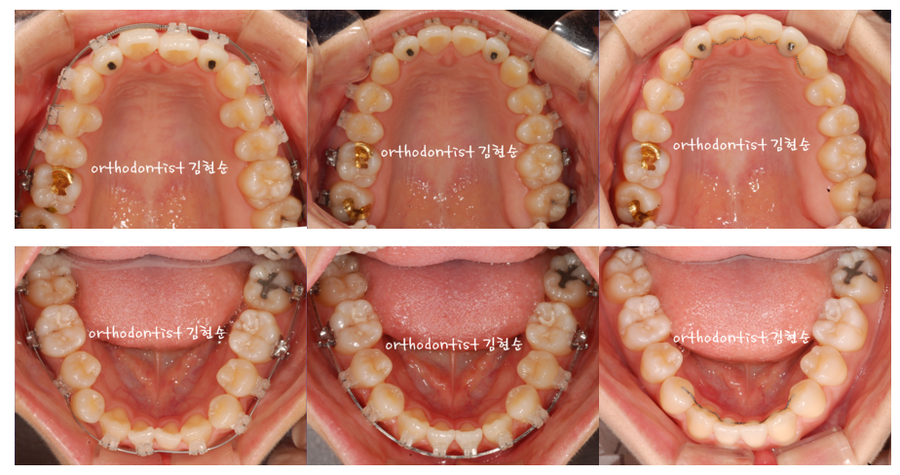 개방교합 비발치 세라믹교정 관련 이미지 10