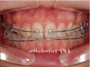 강남 돌출입 교정 관련 이미지 13