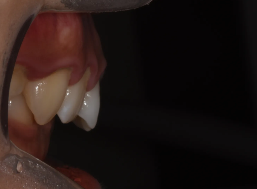 과개교합 교정: 비수술로 치료한 토끼 이빨 이야기 관련 이미지 4