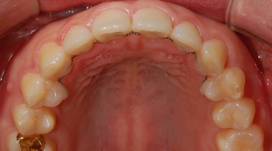 세라믹치과 교정유지장치 종류 관련 이미지 2