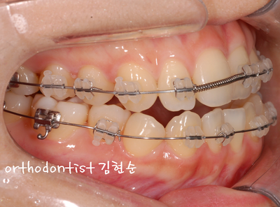 개방 교합 관련 이미지 19