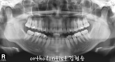 강남 돌출 관련 이미지 6