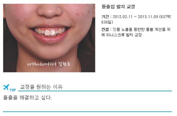 미니스크류, 돌출입 발치 교정 잇몸노출 개선 관련 이미지 4