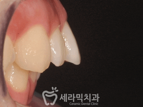 앞니 돌출입과 과개교합 치아교정전후 자신감 넘치는 미소! 관련 이미지 1