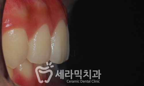 과개교합, 딥바이트 비발치 치아교정전후 관련 이미지 3