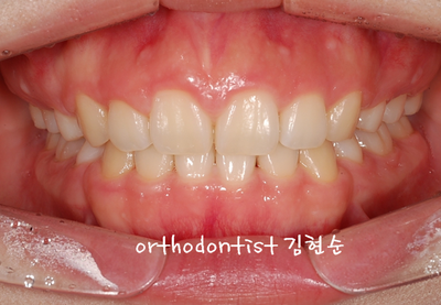 강남 돌출 관련 이미지 29