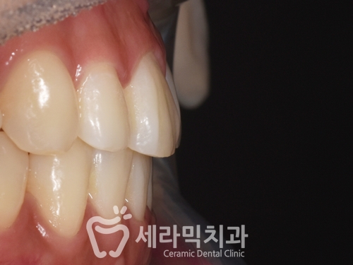 반대교합과 아래 돌출입 치아교정전후 관련 이미지 1