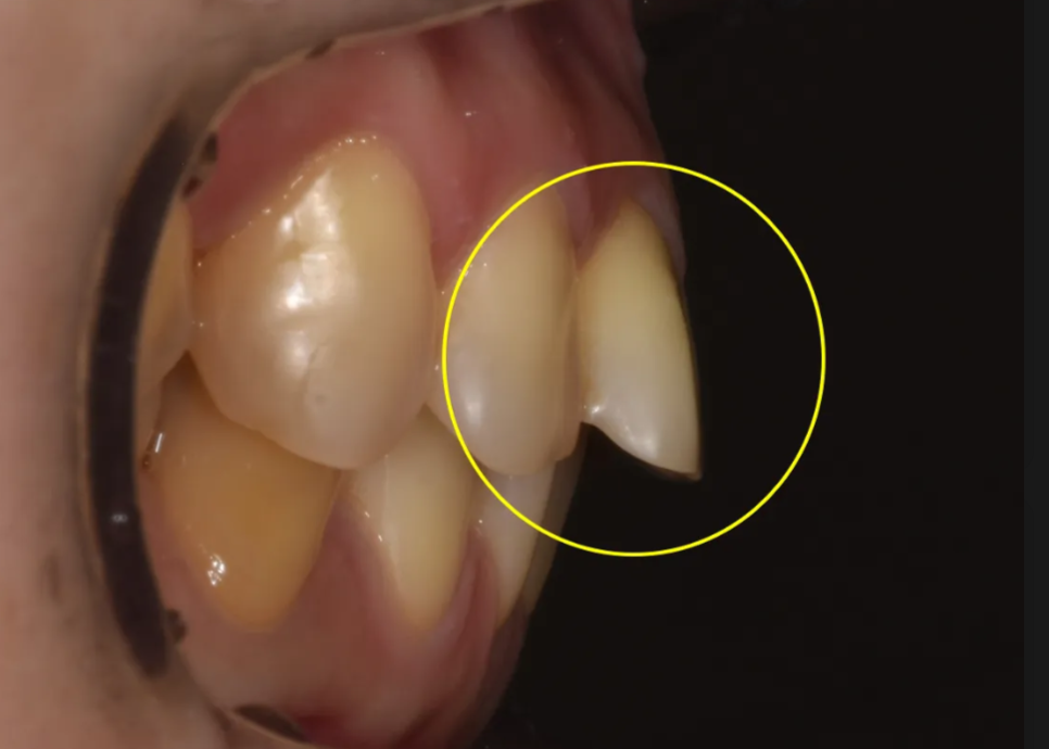 학동역 라미네이트 전후, 치아 모양과 색상 개선 사례 관련 이미지 6