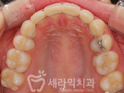과개교합 치아교정잘하는곳, 세라믹치과 치아교정전후! 관련 이미지 29